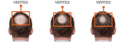 FOLIGAIN Minoxidil 5% Schiuma per la ricrescita dei capelli per uomo Fornitura per 6 mesi