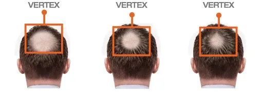 FOLIGAIN Minoxidil 5% Schiuma per la ricrescita dei capelli per uomo Fornitura per 3 mesi